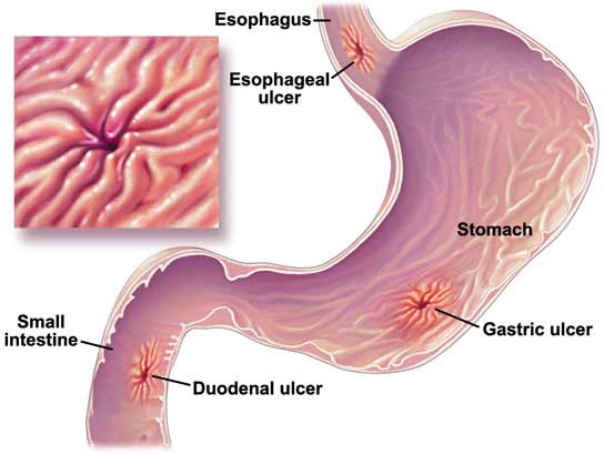 gastrik puasa