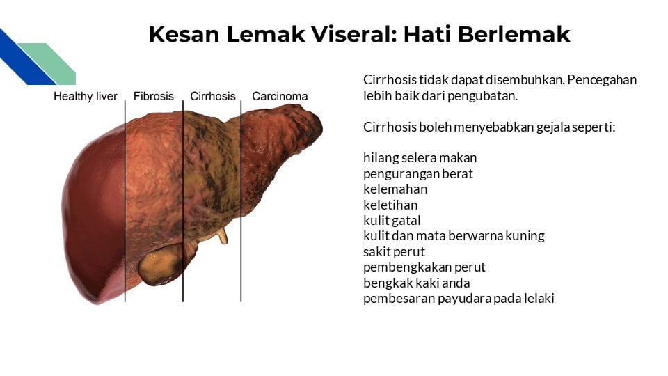 hati berlemak fatty liver berpunca dari obesiti